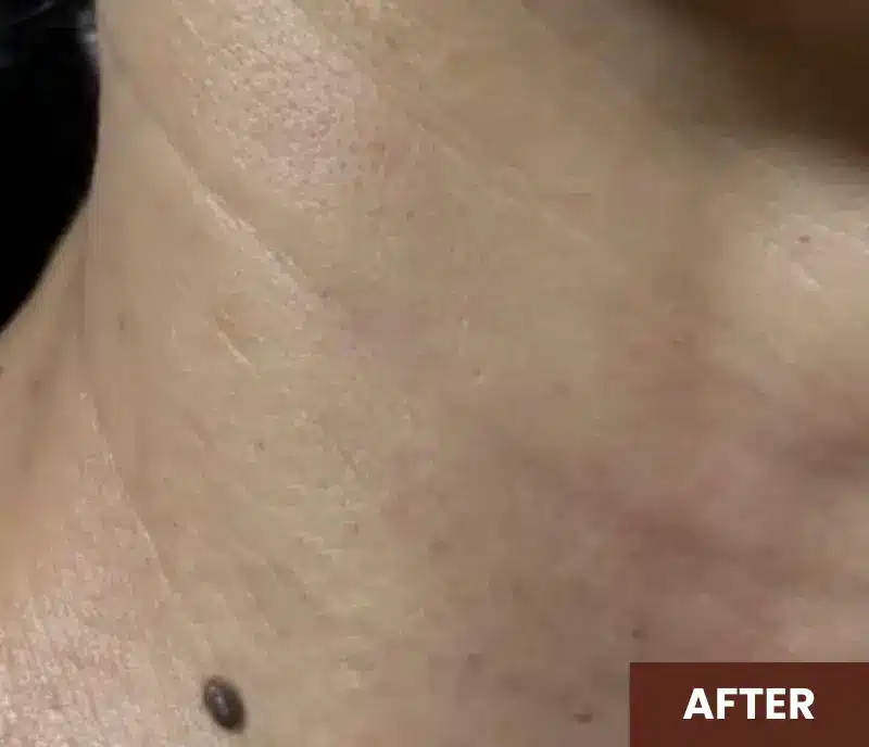Close-up of a person's neck with smooth skin and a visible mole, labeled "AFTER" in the lower right corner.