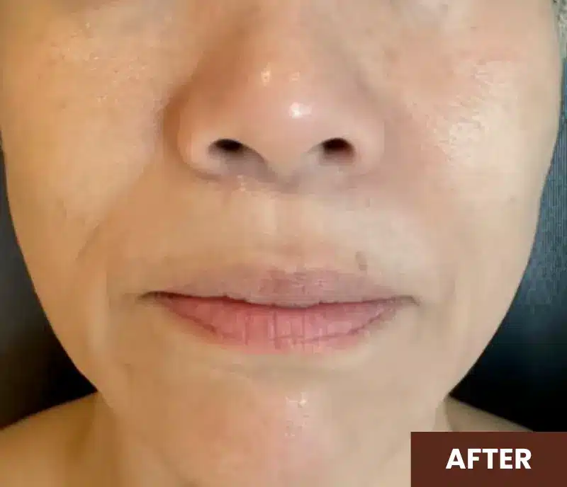 Close-up of the lower half of a person's face with smooth skin and the word "AFTER" in white text on a brown box in the bottom right corner.