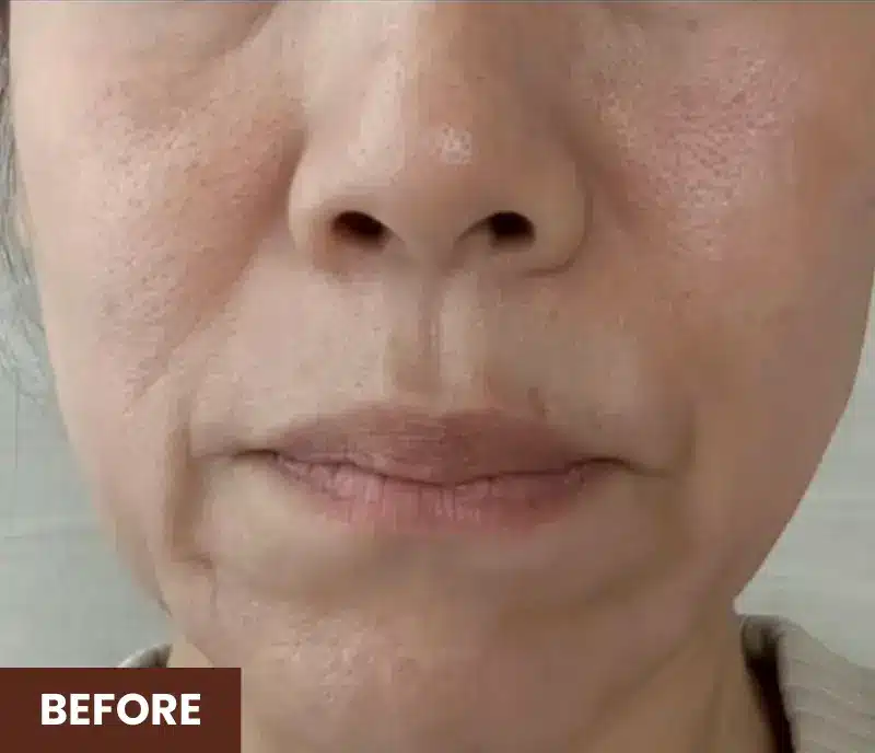 Close-up of a woman's lower face showing visible fine lines, wrinkles, and uneven skin texture. The word "BEFORE" appears in the bottom left corner.