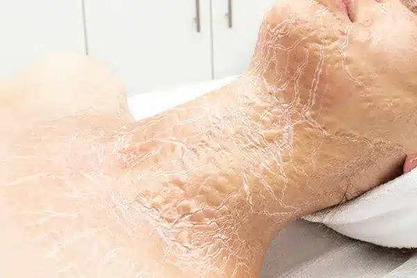A close-up of a person's neck and lower face with visible peeling, dry skin or applied transparent facial mask, likely during a skincare or dermatological treatment.