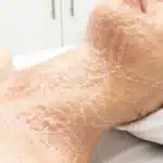 Spa Promotion - Vampire Neck Lines Treatment Promotion