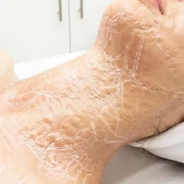 Close-up of a person's neck and jaw area with visibly dry, flaky, and cracked skin, showing signs of dehydration or a skin condition along with pronounced neck lines.