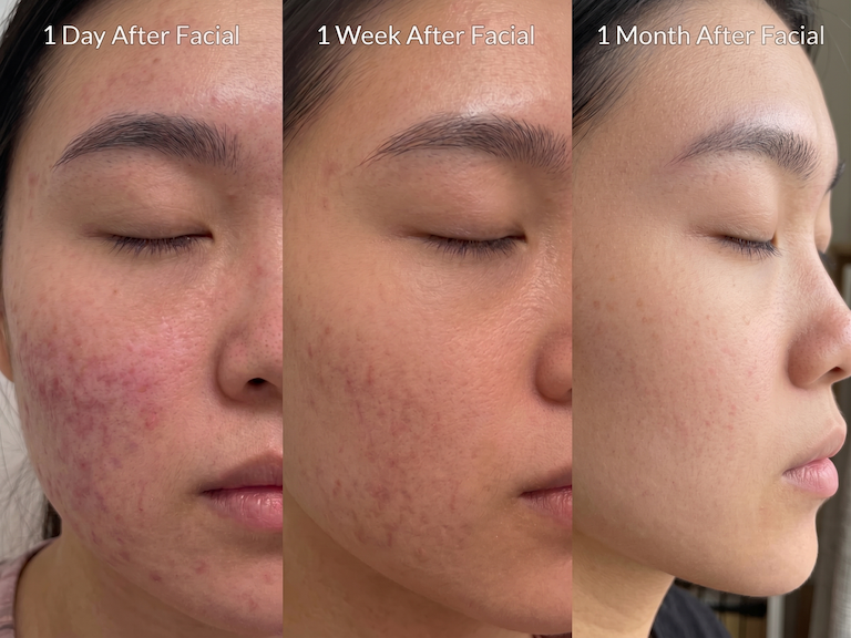 Side-by-side photos of a woman’s face show skin redness and acne marks improving from 1 day to 1 week to 1 month after a facial treatment.