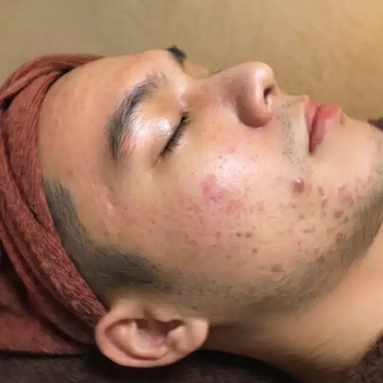 A young person lies with eyes closed, wearing a brown head towel. Their face, prepared for an acne facial, shows visible acne, redness, and a spot on the cheek.