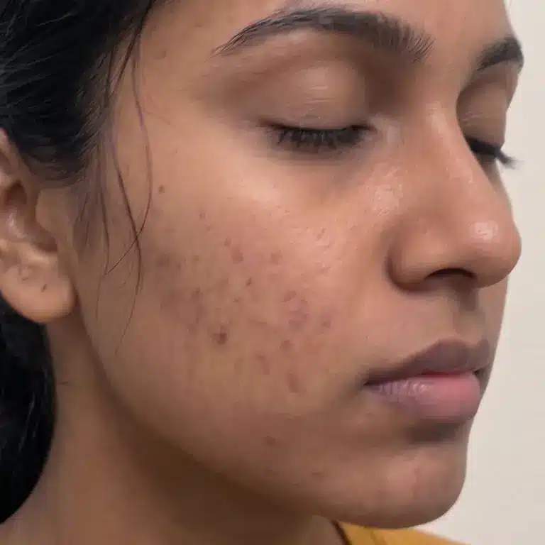 Close-up of a woman's face with eyes closed, showing mild acne scars and uneven skin texture on her cheek, ideal for illustrating the results achievable after an acne facial.